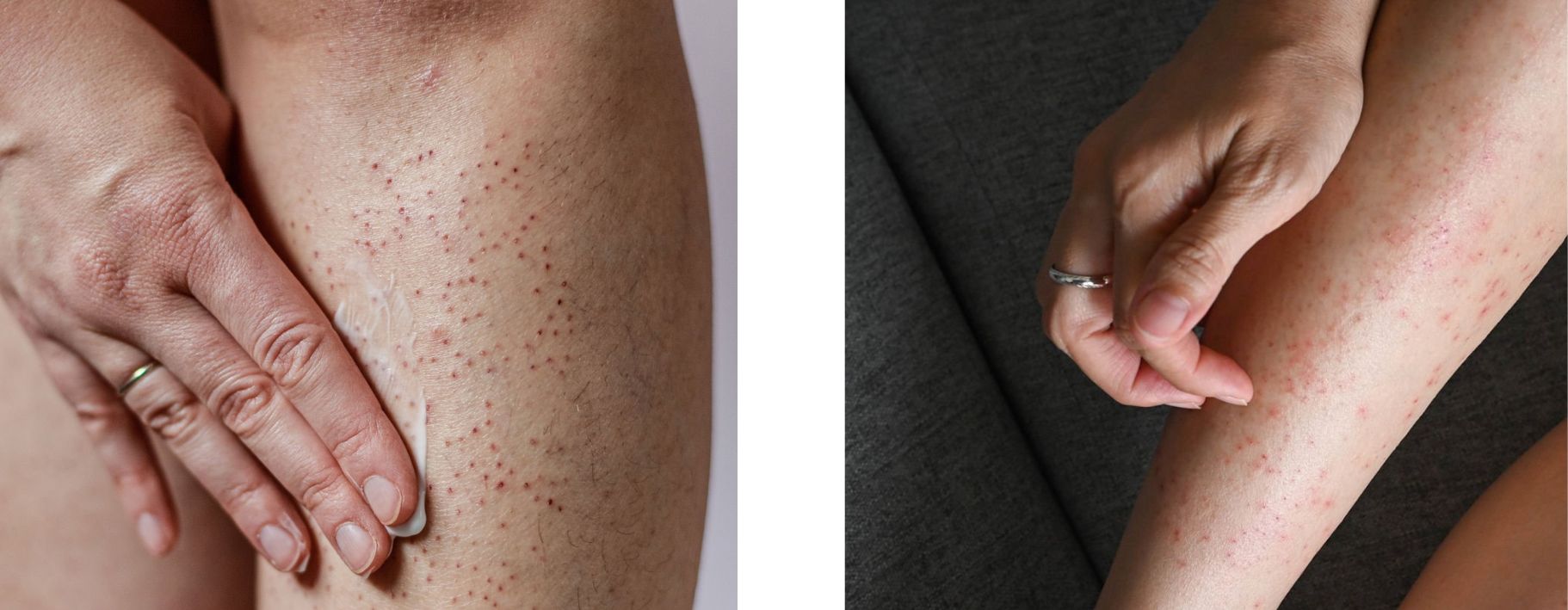 czerwone kropki na nogach jak sie ich pozbyc?